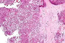 Micrograph showing crystal deposition in an intervertebral disc. H&amp;E stain.