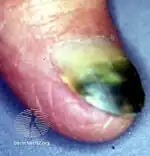 Pseudomonas-candida infection