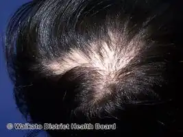 Pseudopelade of Brocq