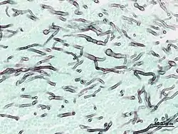 Angioinvasive pulmonary aspergillosis (closeup)