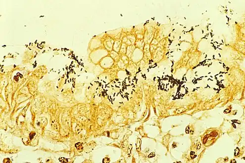 H. pylori colonized on the surface of regenerative epithelium (Warthin-Starry silver stain)