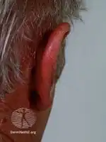 Relapsing polychondritis