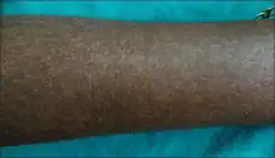 Hyperpigmented macules of forearms