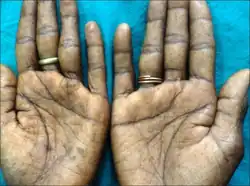 Fine pitting of the palms