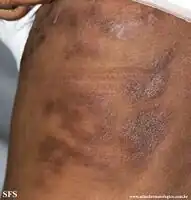 Rheumatoid panniculitis