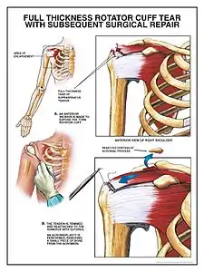 Surgical repair of rotator cuff tear