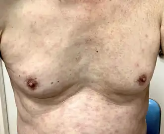 Macular eruption with some scattered papules on his trunk