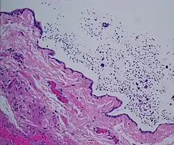 Dilated rete testis containing spermatozoa within cyst lumen. H&E stain 20x
