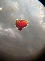 Splinter hemorrhage under the microscope