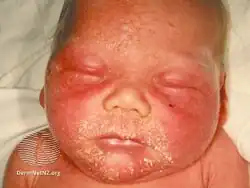 Staphylococcal scalded skin syndrome