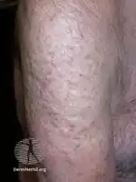 Steatocystoma multiplex