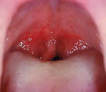 Red throat, red uvula, with red spots on soft palate