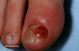 Subungual exostosis big toe