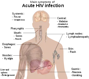 A diagram of a human torso labelled with the most common symptoms of an acute HIV infection