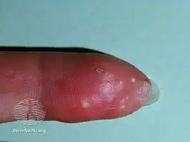 Systemic scleroderma