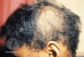 Traction alopecia
