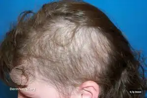 Trichotillomania