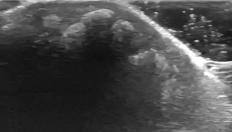 tumorous calcinosis over a malleolus in ultrasound