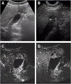 Non-contrast abdominal ultrasound and contrast-enhanced ultrasound (CEUS) of adenomyomatosis of the gallbladder: a The fundus of the gallbladder wall was thickened and the GB wall was obscure. b The intramural echogenic foci were detected by high frequency transducer. c CEUS—arterial phase (22 s) —heterogeneous hyper-enhancement and wall was intact. d CEUS—venous phase (34 s) the anechoic spaces were more clear.