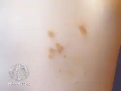 Urticaria pigmentosa