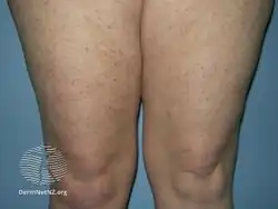 Urticaria pigmentosa