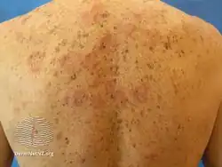 Urticarial vasculitis