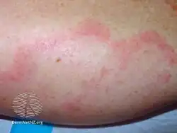 Urticarial vasculitis