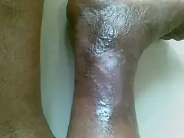 Healing venous ulcer after one month