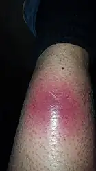 The very first symptom of NF. The center is getting darker red (purple).