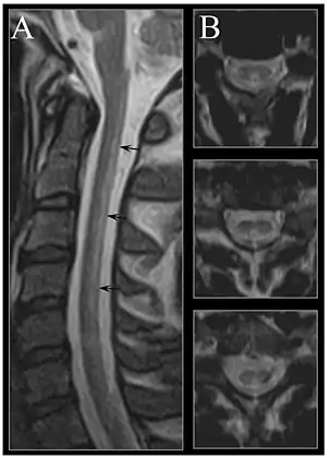 MRI image of the cervical spinal cord in vitamin B12 deficiency showing subacute combined degeneration. (A) The midsagittal T2 weighted image shows linear hyperintensity in the posterior portion of the cervical tract of the spinal cord (black arrows). (B) Axial T2 weighted images reveal the selective involvement of the posterior columns.