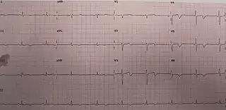 ECG of the same person when pain-free, note the biphasic T waves (type B) in leads V2 and V3
