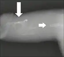 Projectional radiography ("X-ray"), penetrating the soft parts of the penis, showing radiopaque images that correspond to calcifications in the corpora cavernosa (arrows).