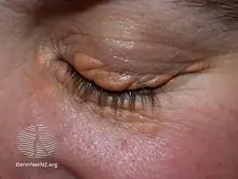 Xanthelasma