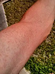 Rash on an arm due to Zika fever