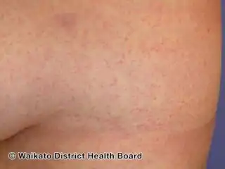 Zika virus infection