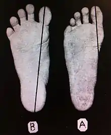 The shape of an adult foot which has never worn shoes (left), contrasted with a foot with mild bunion.[citation needed] The longitudinal line is "Meyer's line", a measure of foot deformity.: 104 