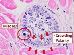 Cellular arrangement, including crowding and cell polarity (common tendencies among cells at the border, such as elongation or &quot;palisading&quot; in this case). Amount of mitoses can also be appreciated at this level.